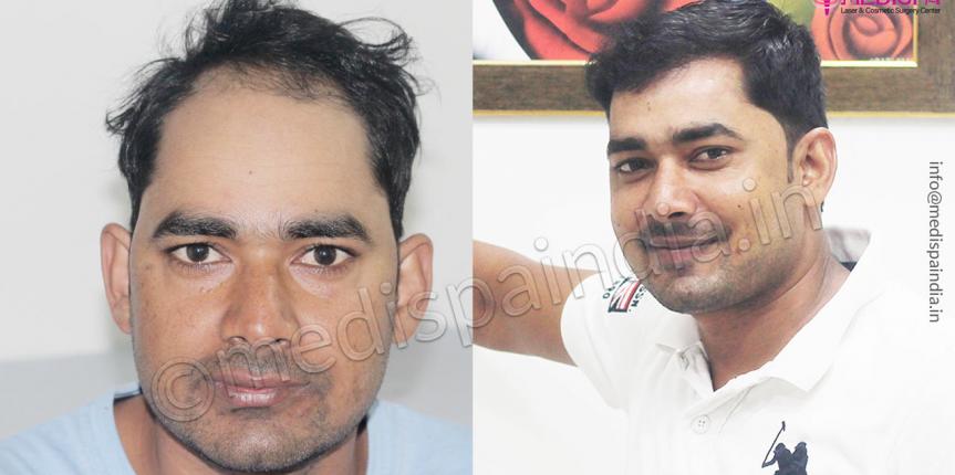 hair transplant clinics results mumbai