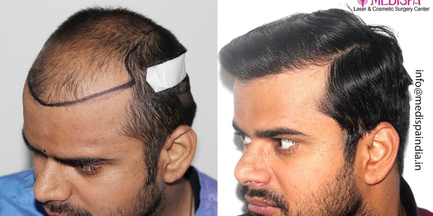 12 month hair transplant result