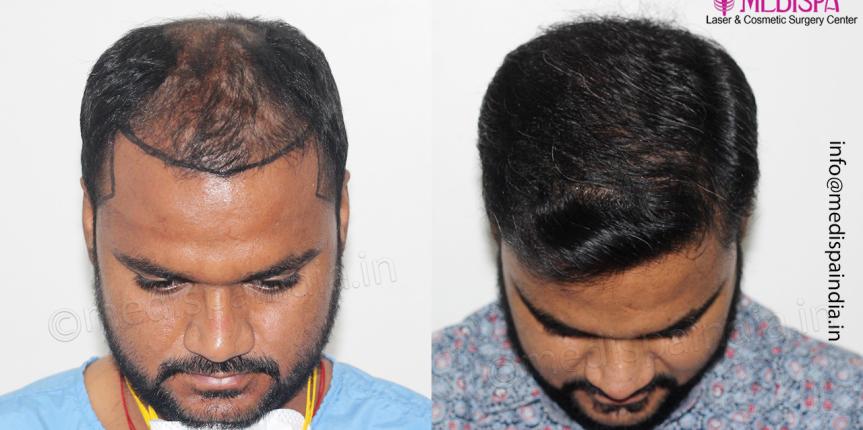 best hair restoration surgeon results in hyderabad