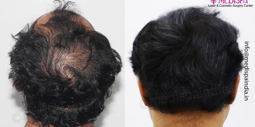 results hair transplant india