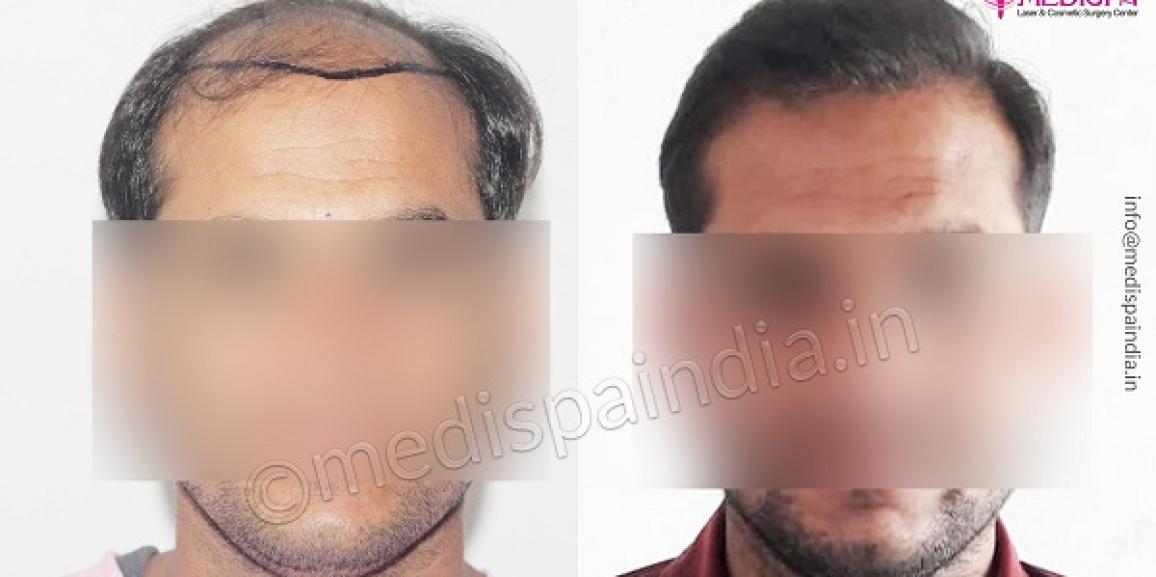 The Advantages of FUT Hair Transplant Procedure