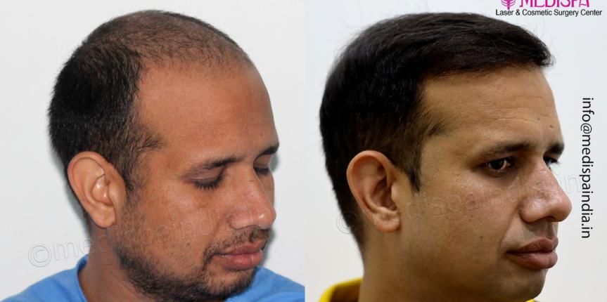 hair transplant results india