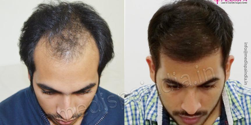 hair transplant rewari