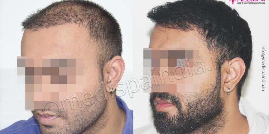 hair transplant chandigarh