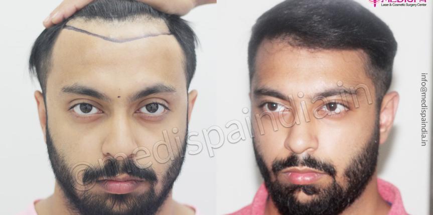 cost of hair transplant