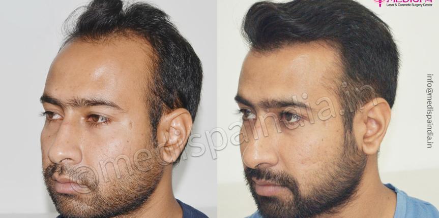 best hair transplant clinics in hyderabad