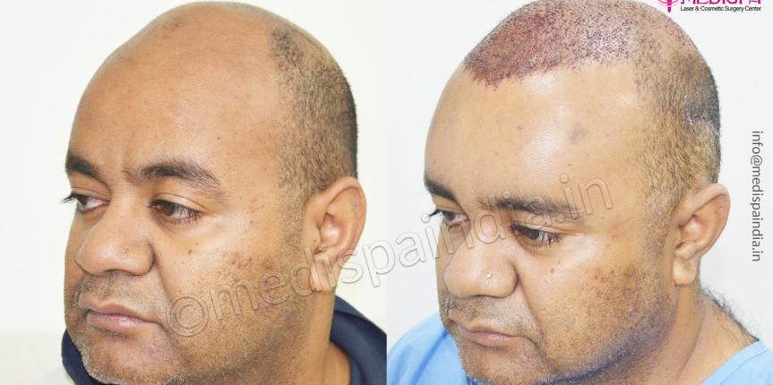 hair restoration results australia