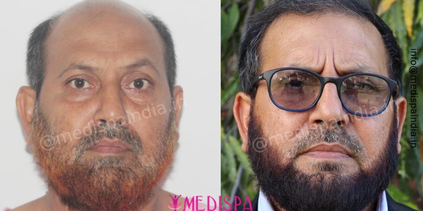 Hair Restoration in India