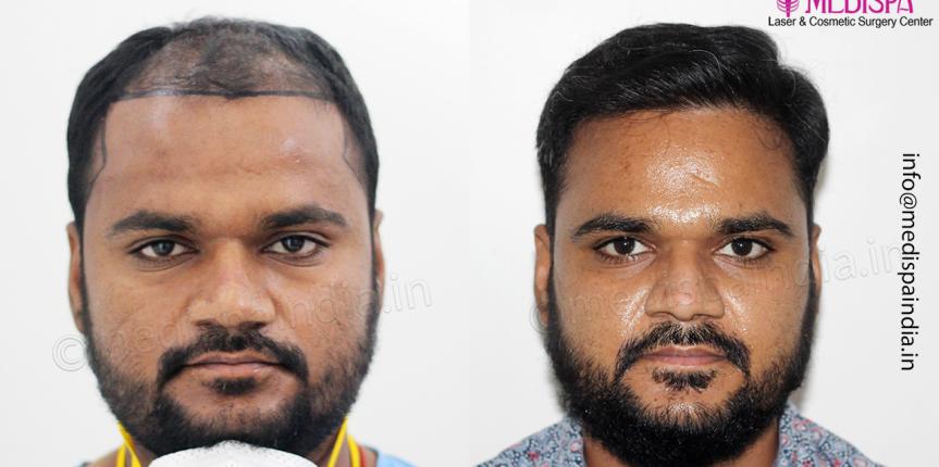 best hair restoration results in hyderabad