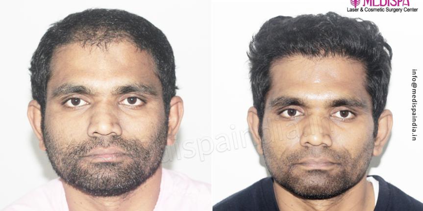 hair transplant before after in india