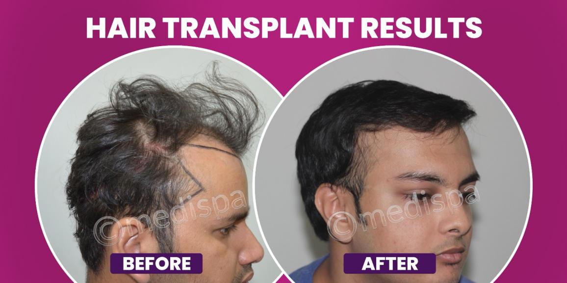 How Primary Consultation Is Helpful In Hair Transplantation?