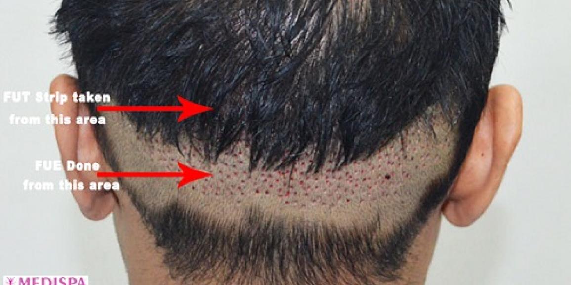 Why FUT+FUE combine method considered the best for hair transplantation?