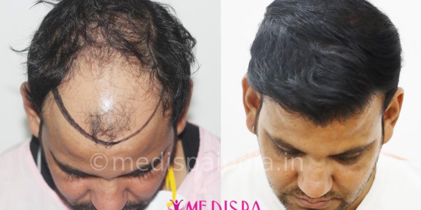 affordable hair transplant cost in jaipur
