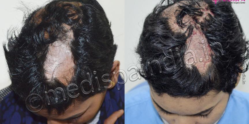 burn hair transplant india