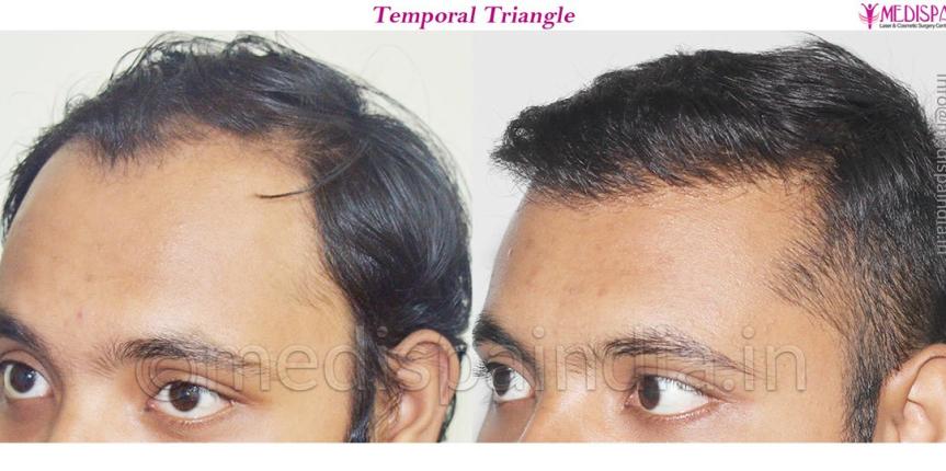 fue hair transplant cost india