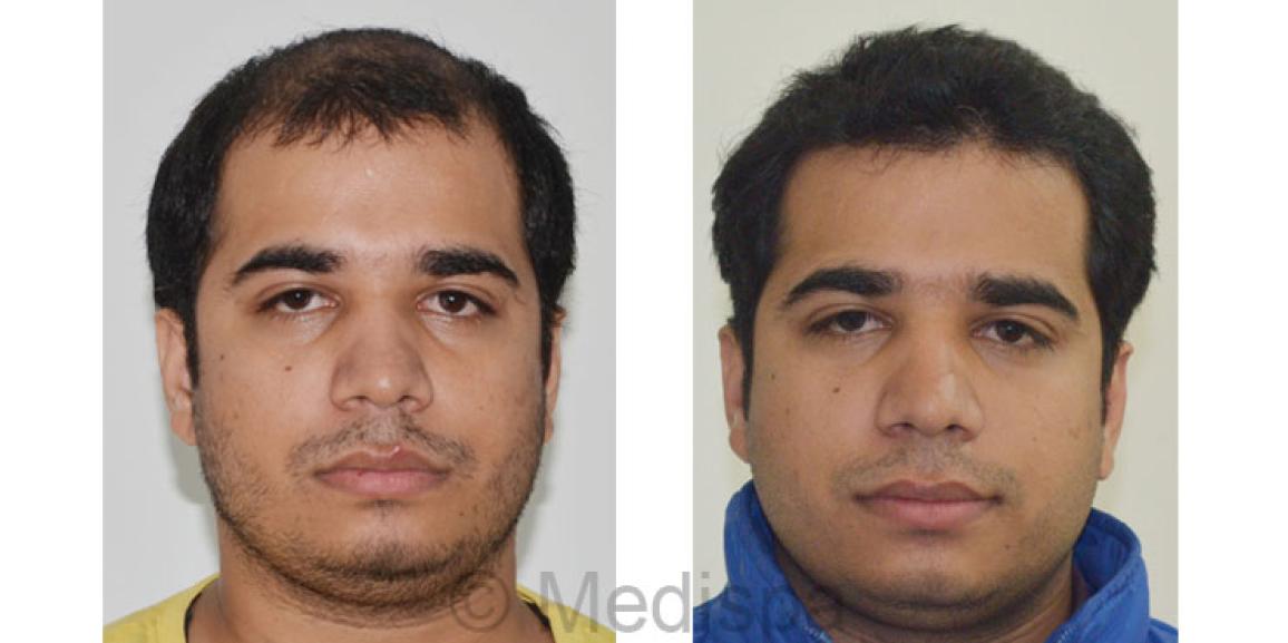 Success Story – FUT Hair Transplant with 3900 Grafts