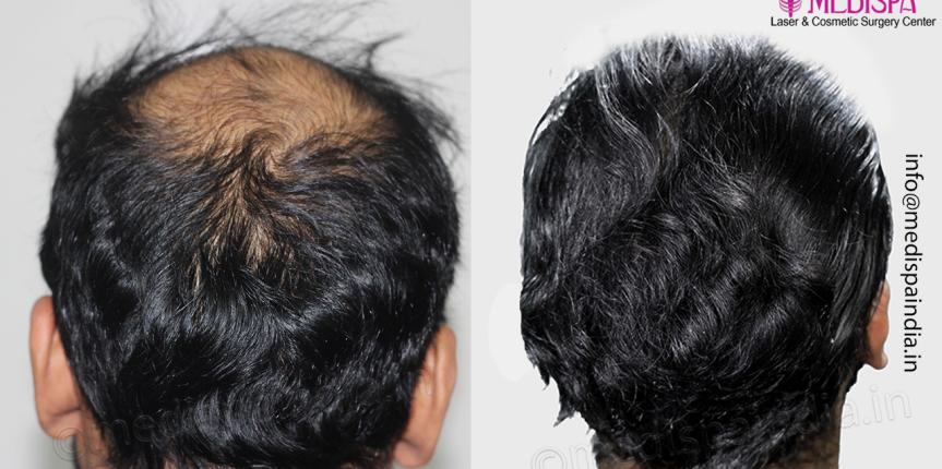 hair transplant result after 12 months