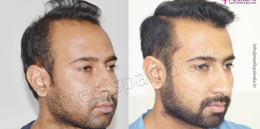 top hair transplant clinics in hyderabad