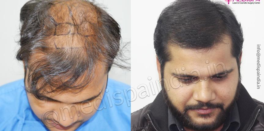 hair transplant delhi cost india