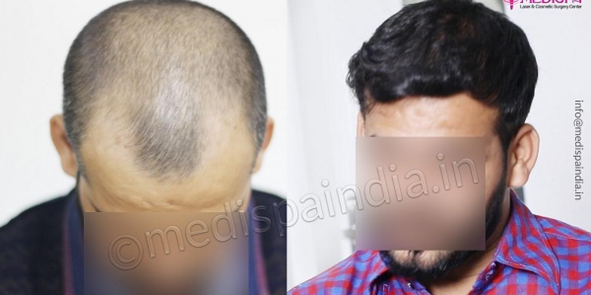 How To Evaluate The Results of Hair Transplant Surgery?