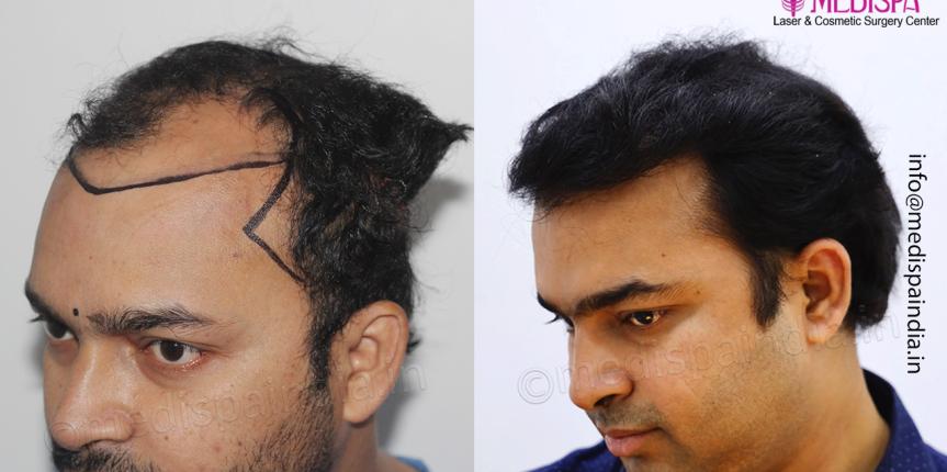 top hair transplant clinic results india