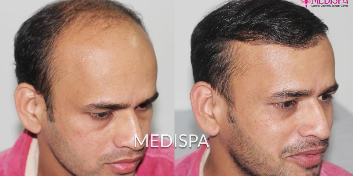 Myths about Hair Transplant Surgery