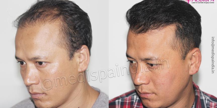 hair transplant results ajmer