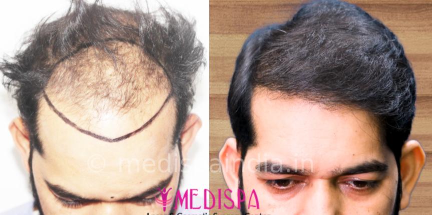 cost of hair transplant