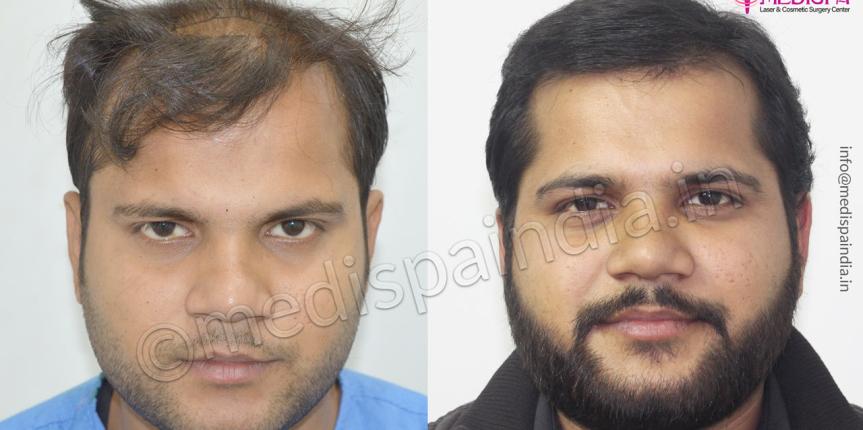 hair transplant gurugram cost