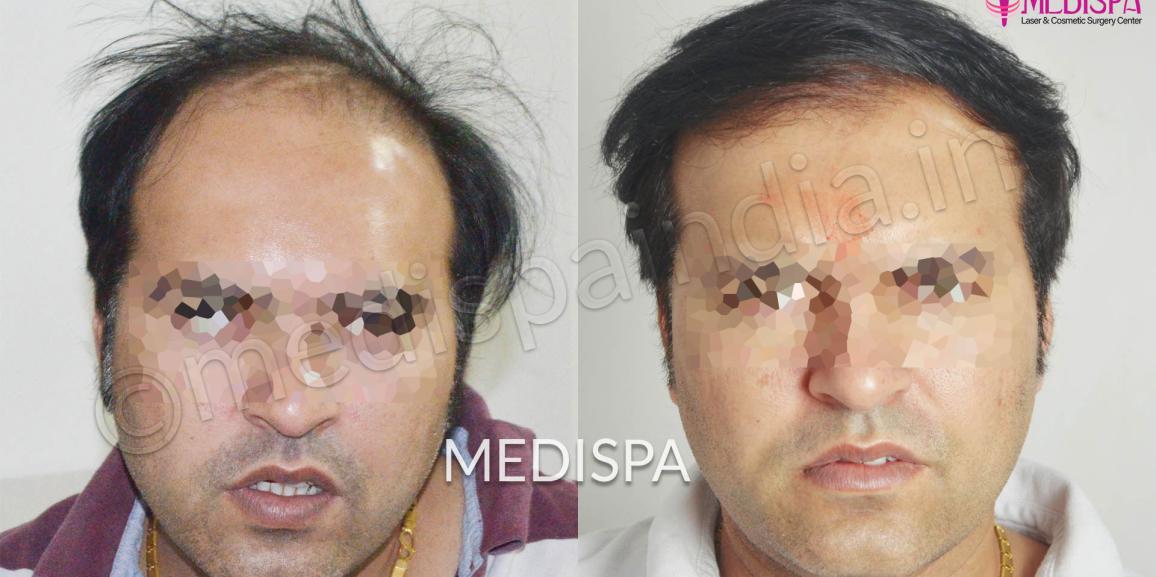 Recent Advancements in Hair Transplant Procedure in Delhi