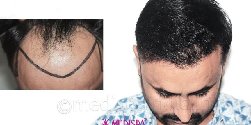 best hair transplant result in delhi