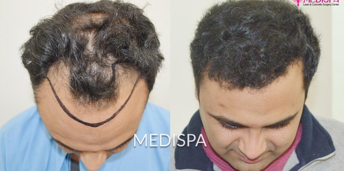 Is it Costly to Get the Bio-stimulated FUT+FUE Hair Transplant