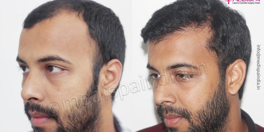 best hair transplant results delhi