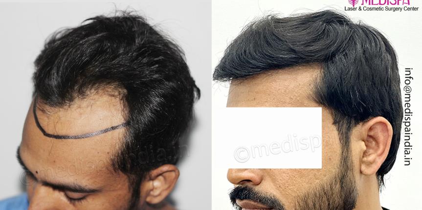 Fue hair transplant results