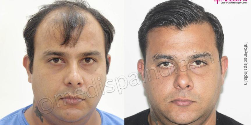 hair transplant in bhubhneshwar