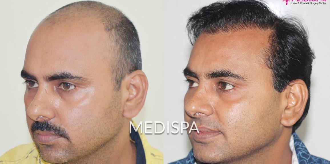 Hair Transplant in India Offers the Best Services