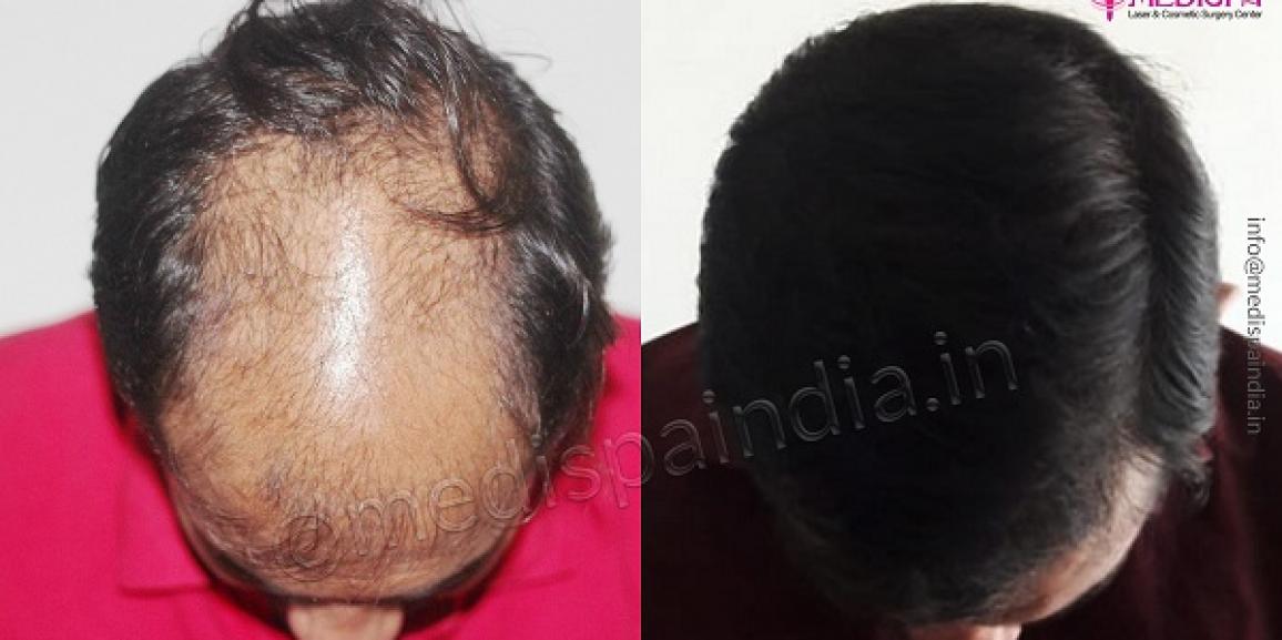 Is It Effective To Have Hair Transplant On Crown Area Of Scalp?