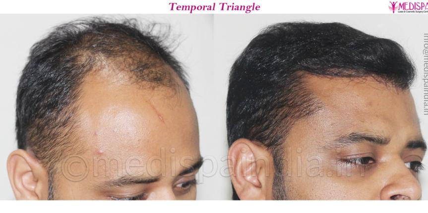 best hair transplant clinic in delhi