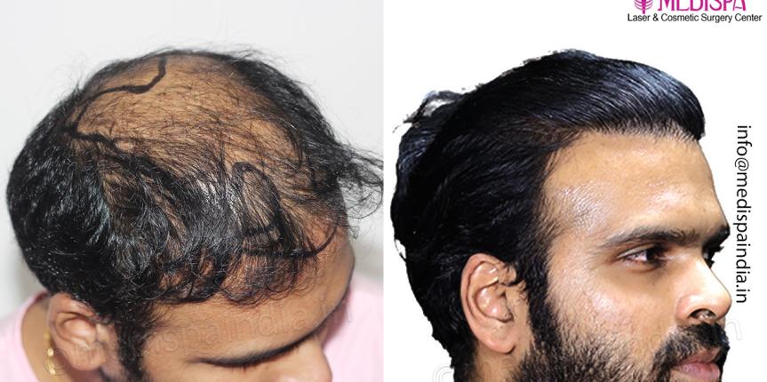 best hair transplant results after 12 months