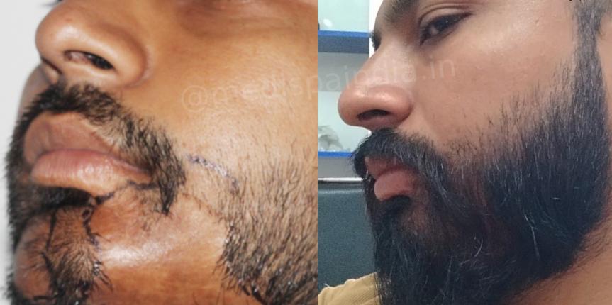 beard hair transplant delhi