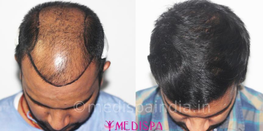 hair restoration cost in delhi india