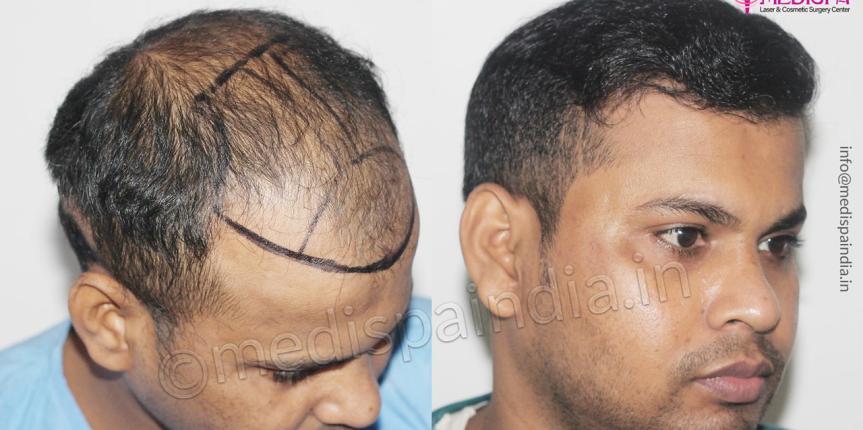 best hair restoration results delhi