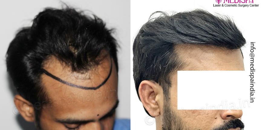 Fue hair transplant result