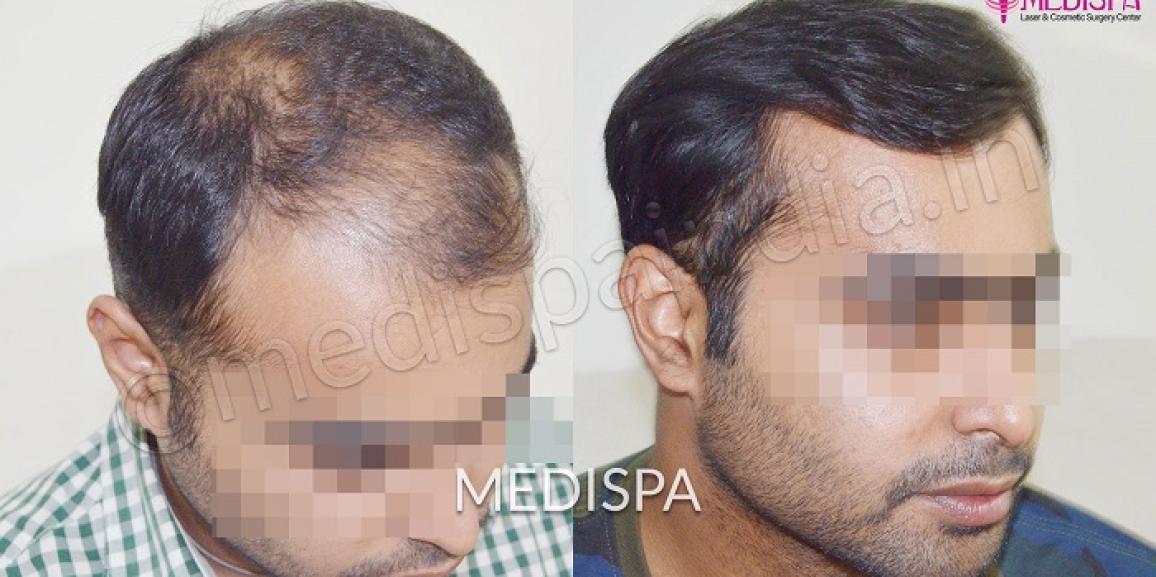 Why Choose Hair Transplant in India