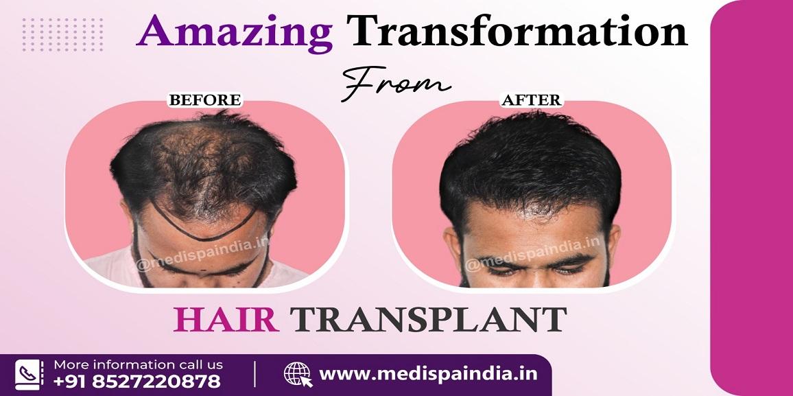 Is It Possible To Get Permanent Solution For Hair Loss By Hair Transplant?