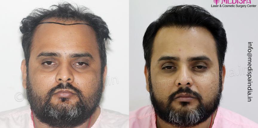 Hair Transplant in Delhi