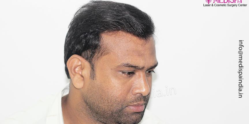 hair transplant results mumbai