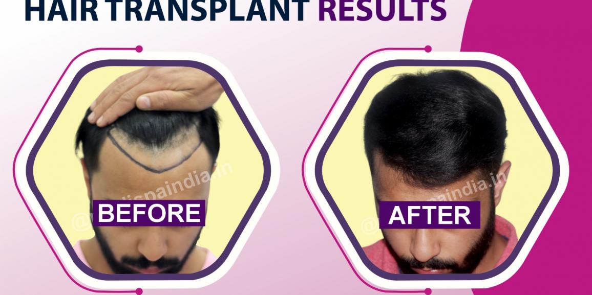 Hair Transplant Success Rate: Understanding The Factors That Affect The Results
