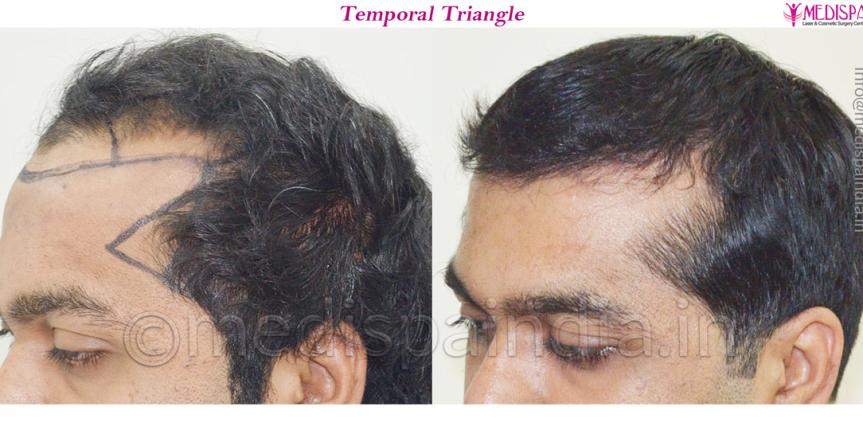 hair transplant in united kingdom