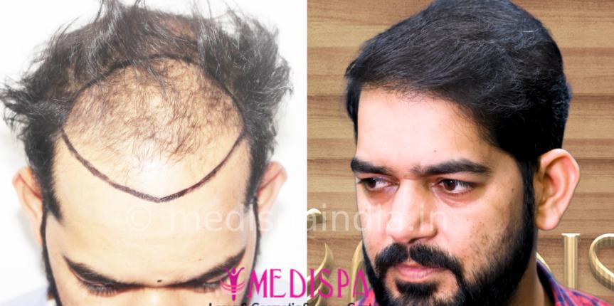 hair transplant price